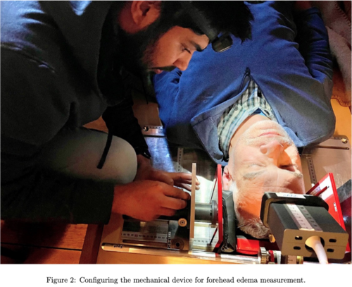 Patel image 2 Figure 2: Configuring the mechanical device for forehead edema measurement.